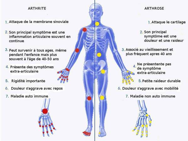 ARTHRITE